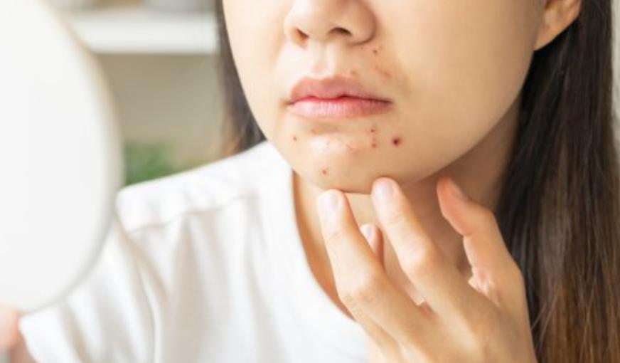 Hạn chế tiếp xúc với vi khuẩn trên gối và ngăn ngừa mụn hiệu quả